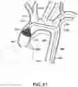 Fig. 22 - Endovascular device with expandable filter