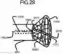 Fig. 33 - Endovascular device with expandable filter