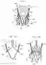 Fig. 02 - Sinus-engaging valve fixation member