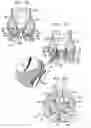 Fig. 11 - Sinus-engaging valve fixation member