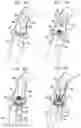 Fig. 13 - Sinus-engaging valve fixation member