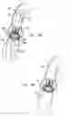 Fig. 14 - Sinus-engaging valve fixation member