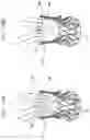 Fig. 16 - Sinus-engaging valve fixation member