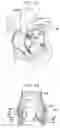 Fig. 21 - Sinus-engaging valve fixation member