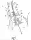 Fig. 02 - DEVICES, SYSTEMS AND METHODS TO IMPROVE PLACEMENT AND/OR PREVENT HEART BLOCK WITH PERCUTANEOUS AORTIC VALVE REPLACEMENT