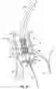 Fig. 22 - DEVICES, SYSTEMS AND METHODS TO IMPROVE PLACEMENT AND/OR PREVENT HEART BLOCK WITH PERCUTANEOUS AORTIC VALVE REPLACEMENT