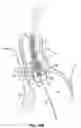 Fig. 40 - DEVICES, SYSTEMS AND METHODS TO IMPROVE PLACEMENT AND/OR PREVENT HEART BLOCK WITH PERCUTANEOUS AORTIC VALVE REPLACEMENT