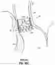 Fig. 46 - DEVICES, SYSTEMS AND METHODS TO IMPROVE PLACEMENT AND/OR PREVENT HEART BLOCK WITH PERCUTANEOUS AORTIC VALVE REPLACEMENT