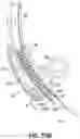 Fig. 69 - DEVICES, SYSTEMS AND METHODS TO IMPROVE PLACEMENT AND/OR PREVENT HEART BLOCK WITH PERCUTANEOUS AORTIC VALVE REPLACEMENT