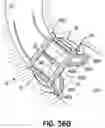 Fig. 76 - DEVICES, SYSTEMS AND METHODS TO IMPROVE PLACEMENT AND/OR PREVENT HEART BLOCK WITH PERCUTANEOUS AORTIC VALVE REPLACEMENT