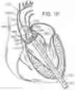 Fig. 07 - Retaining mechanisms for prosthetic valves