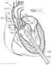 Fig. 08 - Retaining mechanisms for prosthetic valves