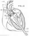 Fig. 09 - Retaining mechanisms for prosthetic valves