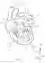 Fig. 02 - Apical Control Of Transvascular Delivery Of Prosthetic Mitral Valve
