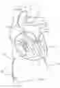 Fig. 04 - Apical Control Of Transvascular Delivery Of Prosthetic Mitral Valve