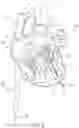 Fig. 06 - Apical Control Of Transvascular Delivery Of Prosthetic Mitral Valve