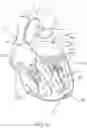 Fig. 07 - Apical Control Of Transvascular Delivery Of Prosthetic Mitral Valve