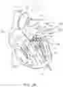 Fig. 28 - Apical Control Of Transvascular Delivery Of Prosthetic Mitral Valve