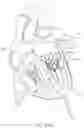 Fig. 44 - Apical Control Of Transvascular Delivery Of Prosthetic Mitral Valve