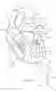 Fig. 45 - Apical Control Of Transvascular Delivery Of Prosthetic Mitral Valve