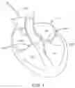 Fig. 02 - DEVICES AND METHODS FOR HEART VALVE REPAIR
