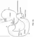 Fig. 02 - Devices and methods for placing a gastrointestinal device