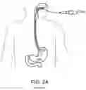 Fig. 04 - Devices and methods for placing a gastrointestinal device