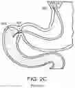 Fig. 06 - Devices and methods for placing a gastrointestinal device