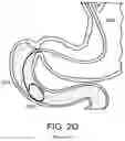 Fig. 07 - Devices and methods for placing a gastrointestinal device
