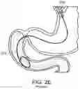 Fig. 08 - Devices and methods for placing a gastrointestinal device