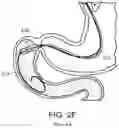 Fig. 09 - Devices and methods for placing a gastrointestinal device