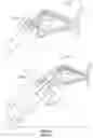Fig. 09 - Nasolacrimal duct stent assembly and method