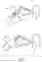 Fig. 10 - Nasolacrimal duct stent assembly and method