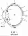 Fig. 02 - System and method for clearing an obstruction from the path of a surgical laser