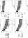 Fig. 10 - Methods of treating Fabry patients having renal impairment