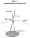 Fig. 05 - Gene therapy for AADC deficiency