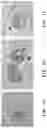 Fig. 02 - Method for culturing a subpopulation of circulating epithelial tumour cells from a body fluid