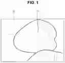 Fig. 02 - External light interference removal method