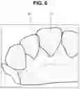 Fig. 06 - External light interference removal method