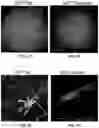 Fig. 07 - Altered material morphology for reducing fibrotic load, reducing noise and improving extractability of implantable leads