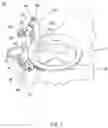 Fig. 02 - Scleral depression mechanical assist device
