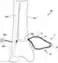Fig. 01 - Partially assembled knotless suture construct