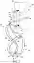 Fig. 08 - Partially assembled knotless suture construct