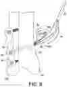 Fig. 09 - Partially assembled knotless suture construct