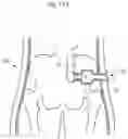 Fig. 115 - APPARATUS FOR CONTROLLING FLOW IN A BODILY ORGAN