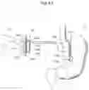 Fig. 43 - APPARATUS FOR CONTROLLING FLOW IN A BODILY ORGAN