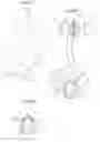 Fig. 45 - APPARATUS FOR CONTROLLING FLOW IN A BODILY ORGAN