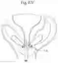 Fig. 71 - APPARATUS FOR CONTROLLING FLOW IN A BODILY ORGAN