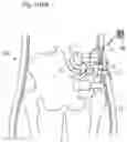 Fig. 84 - APPARATUS FOR CONTROLLING FLOW IN A BODILY ORGAN