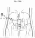 Fig. 85 - APPARATUS FOR CONTROLLING FLOW IN A BODILY ORGAN